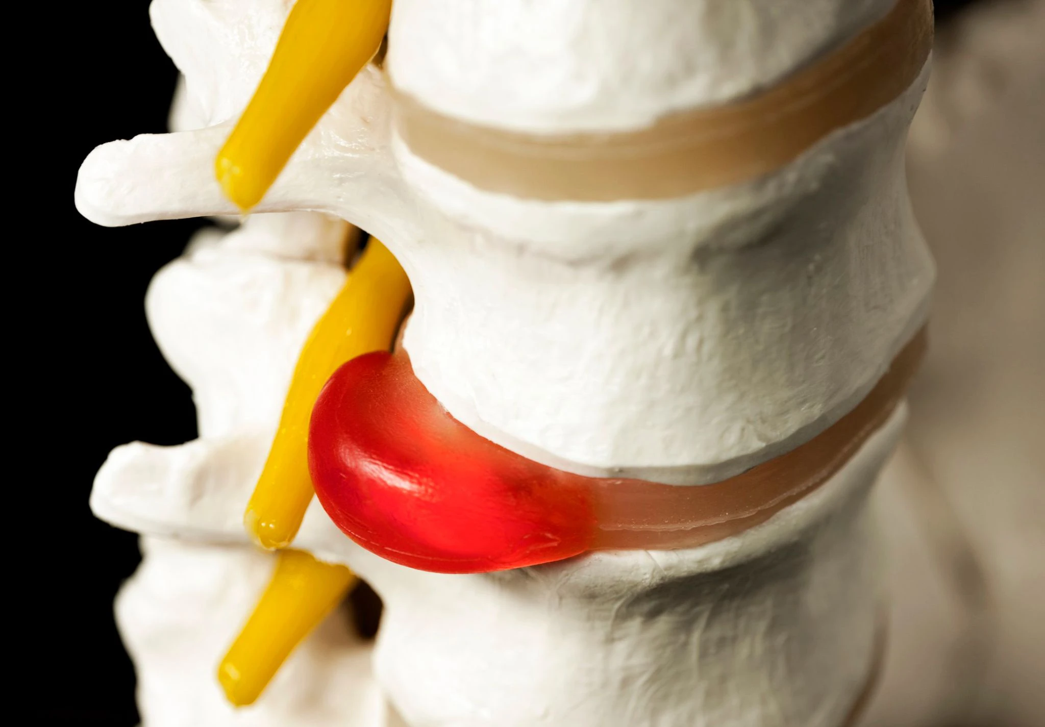 ¿Puede Desaparecer una Hernia Discal?